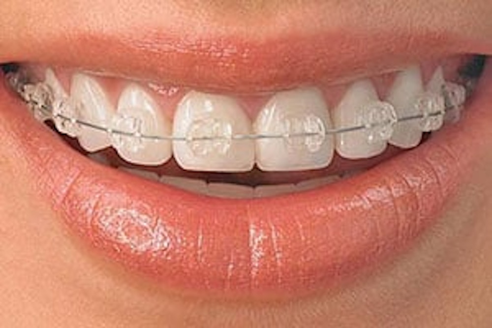 Teen Braces at Seapoint Clinic