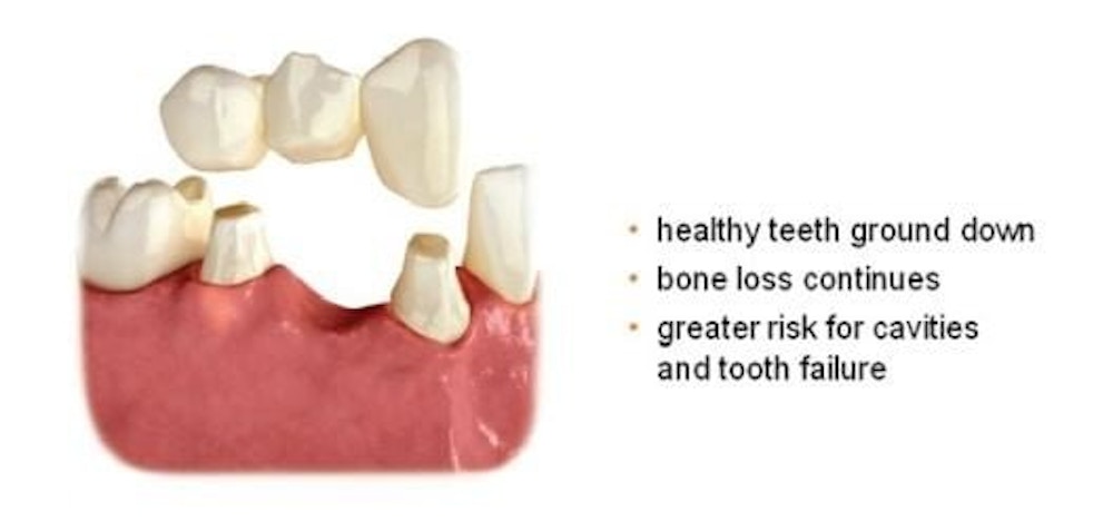 bridge, dental bridge, dentist, implant bridge, tooth bridge, dental implant