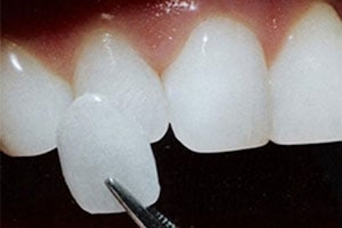 “Should I get Veneers?” - 3 Things Your Dentist Wants to Tell You.