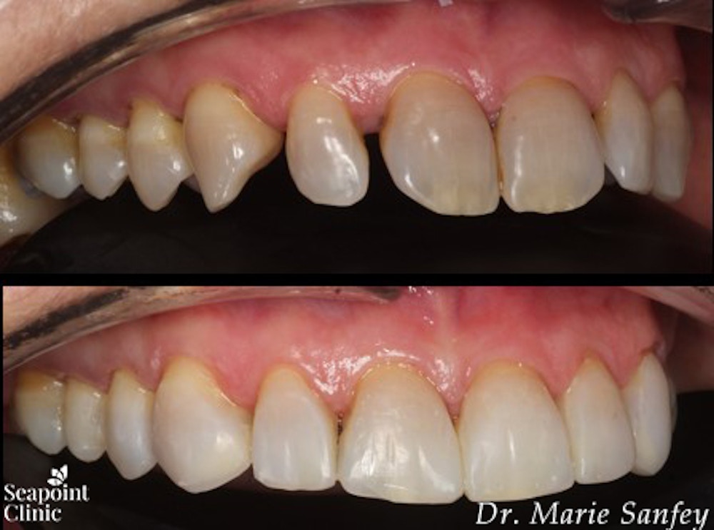 instant veneers, seapoint clinic, dr. marie sanfey