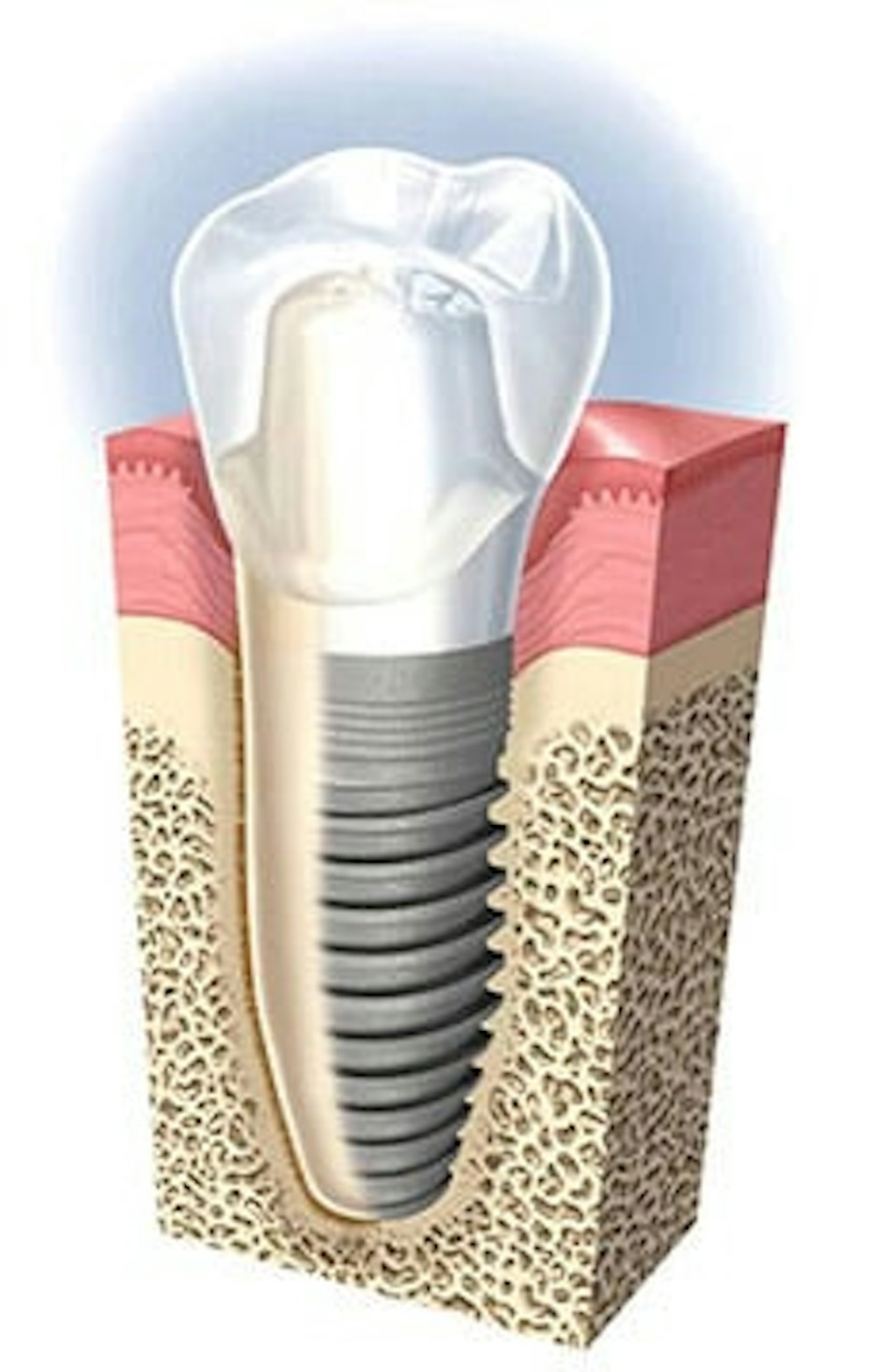 dental implant graph, implant dentistry, holistic