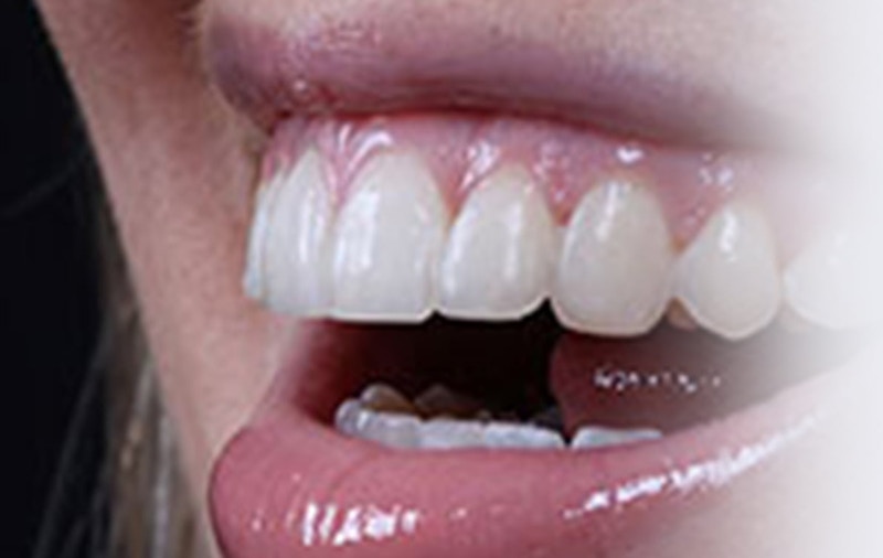 six month braces invisalign cosmetic dentistry