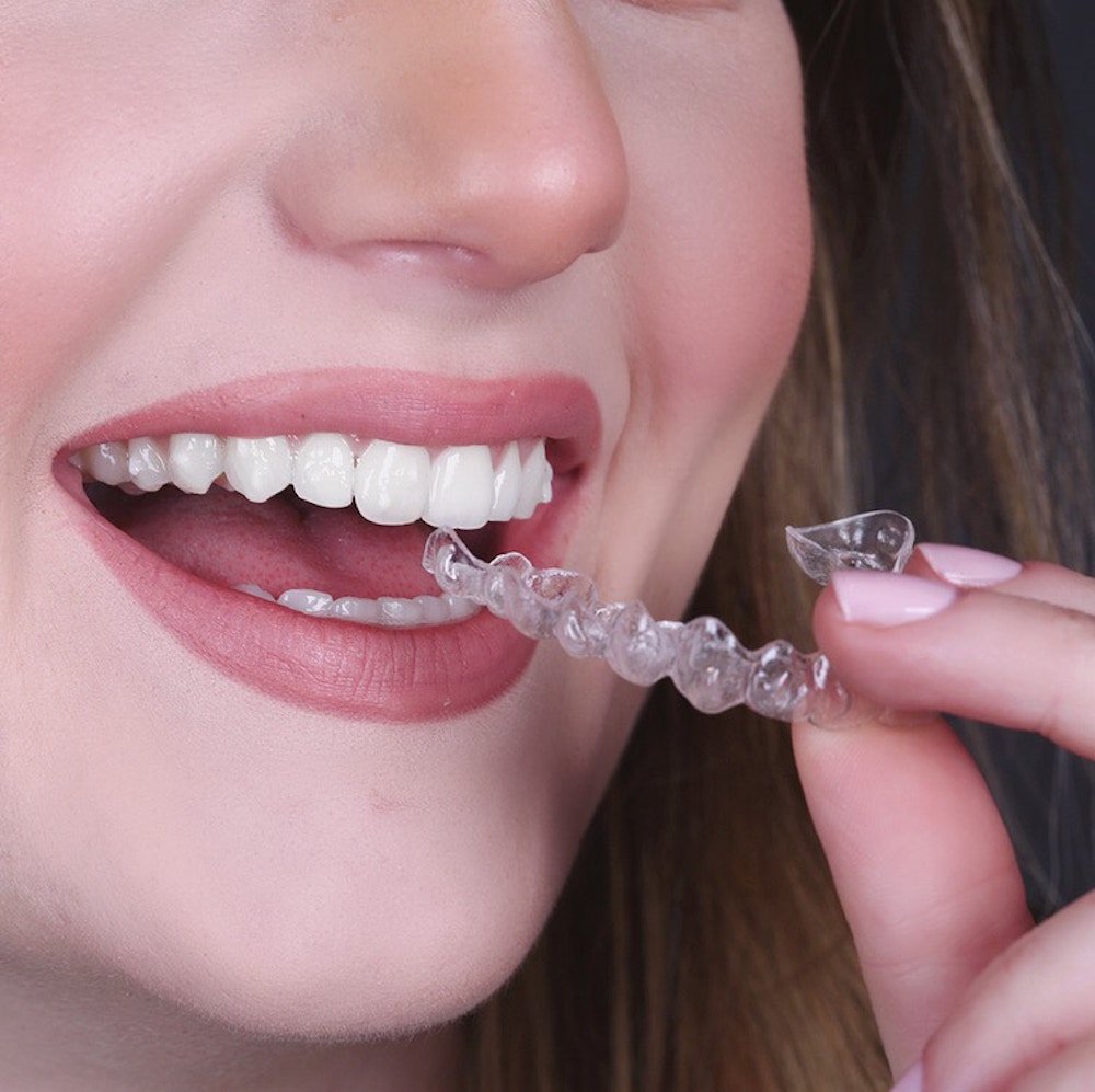 Reasons Invisible Braces Are Ideal