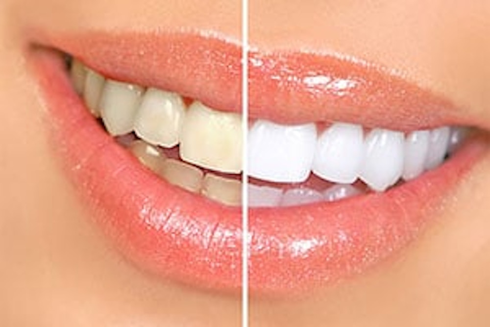 Seapoint Clinic Teeth Whitening