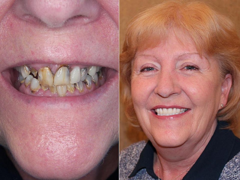 click-tite dentures, dental implants dublin, click-tite, dental implant cost, cheap dental implants, missing teeth, full mouth implants