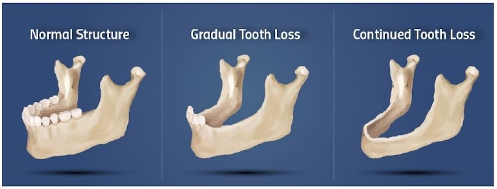 dentures, dental bridge, dental implant, dentures, seapoint clinic, dentist, missing teeth, dublin dentist