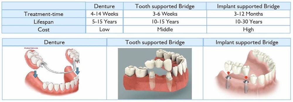 denture bridge dental implant bridge