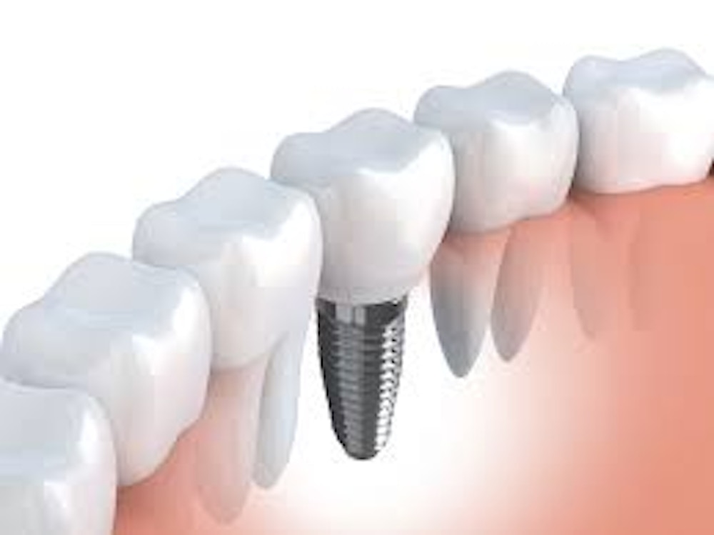 Forces on Dental Implants