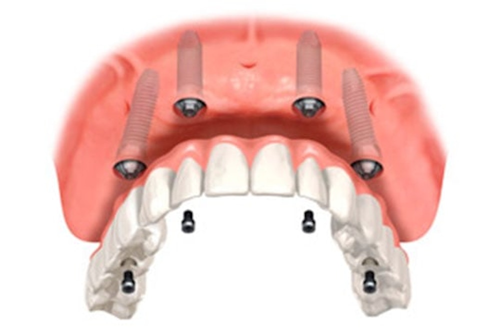 full mouth implants, implant dentistry, fixed teeth, all on 4