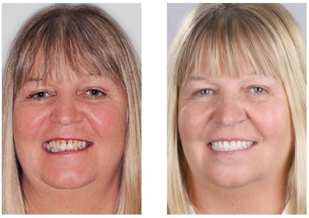 jacinta dental implants before after