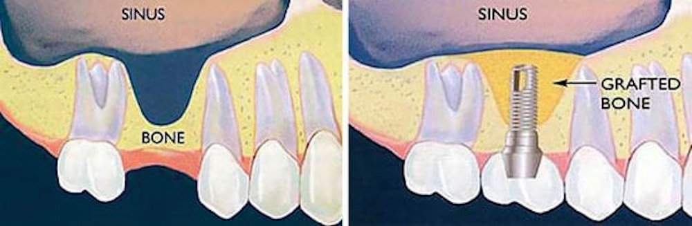 sinus graft for dental implants, oral surgery, dublin dentist, dental clinic, grafting
