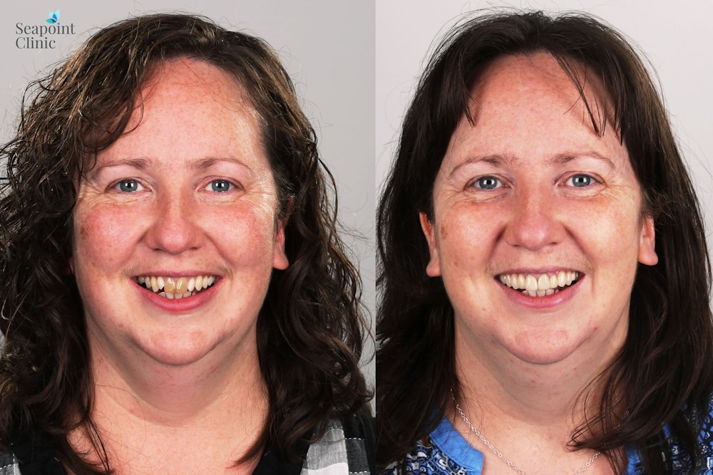 cosmetic dentistry, dentist, digital smile design, before and after, patient review, smile design