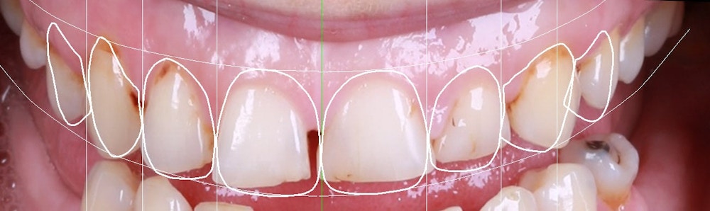 tooth gap graph, seapoint clinic, implant dentistry