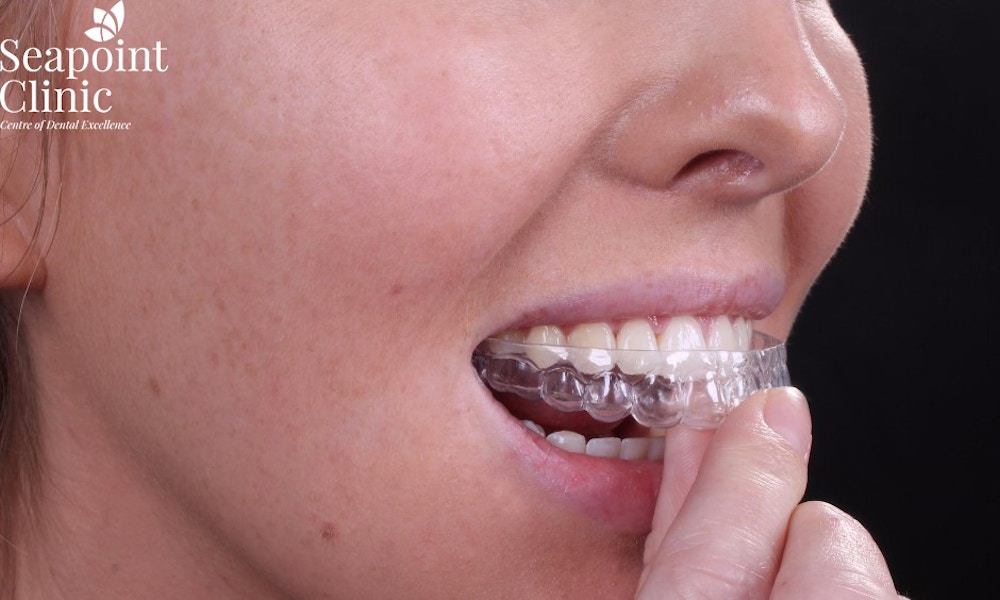 seapoint clinic aligner, orthodontist, orthodontics, six month braces, 6 month braces, braces, invisalign