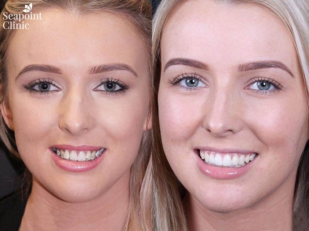 seapoint, invisible braces, cosmetic dentist, six month braces, 6 month braces, braces