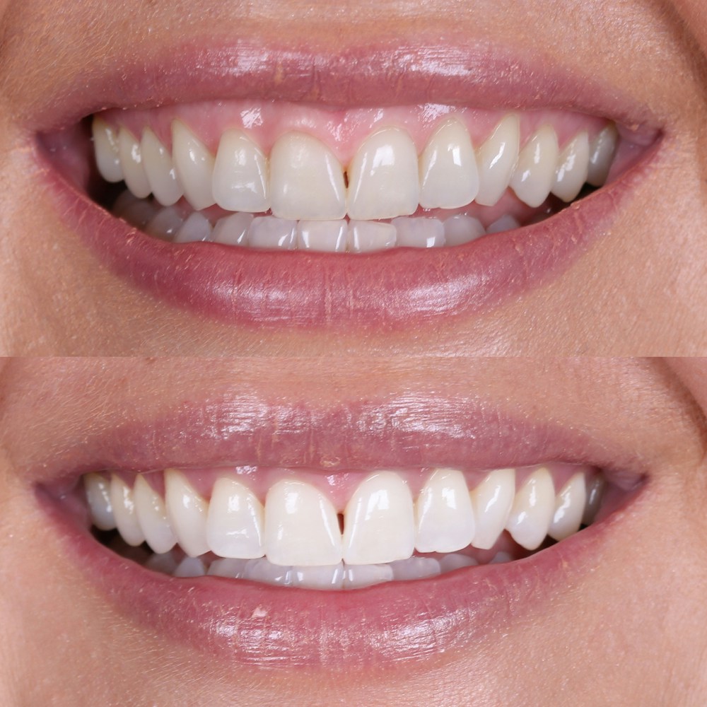 Teeth Whitening Results