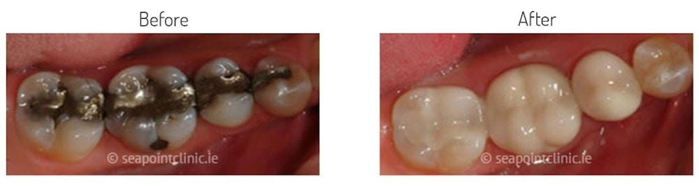 white fillings, cosmetic filling, cosmetic dentist, dental clinic, recommended dentist